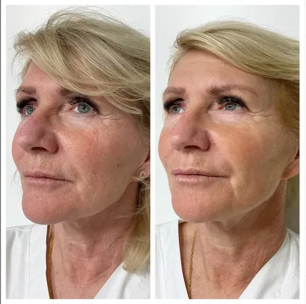 Före och efter Profhilo: jämnare hudton och mindre rodnad över kind och näsa, slätare hudyta på hals och käklinje